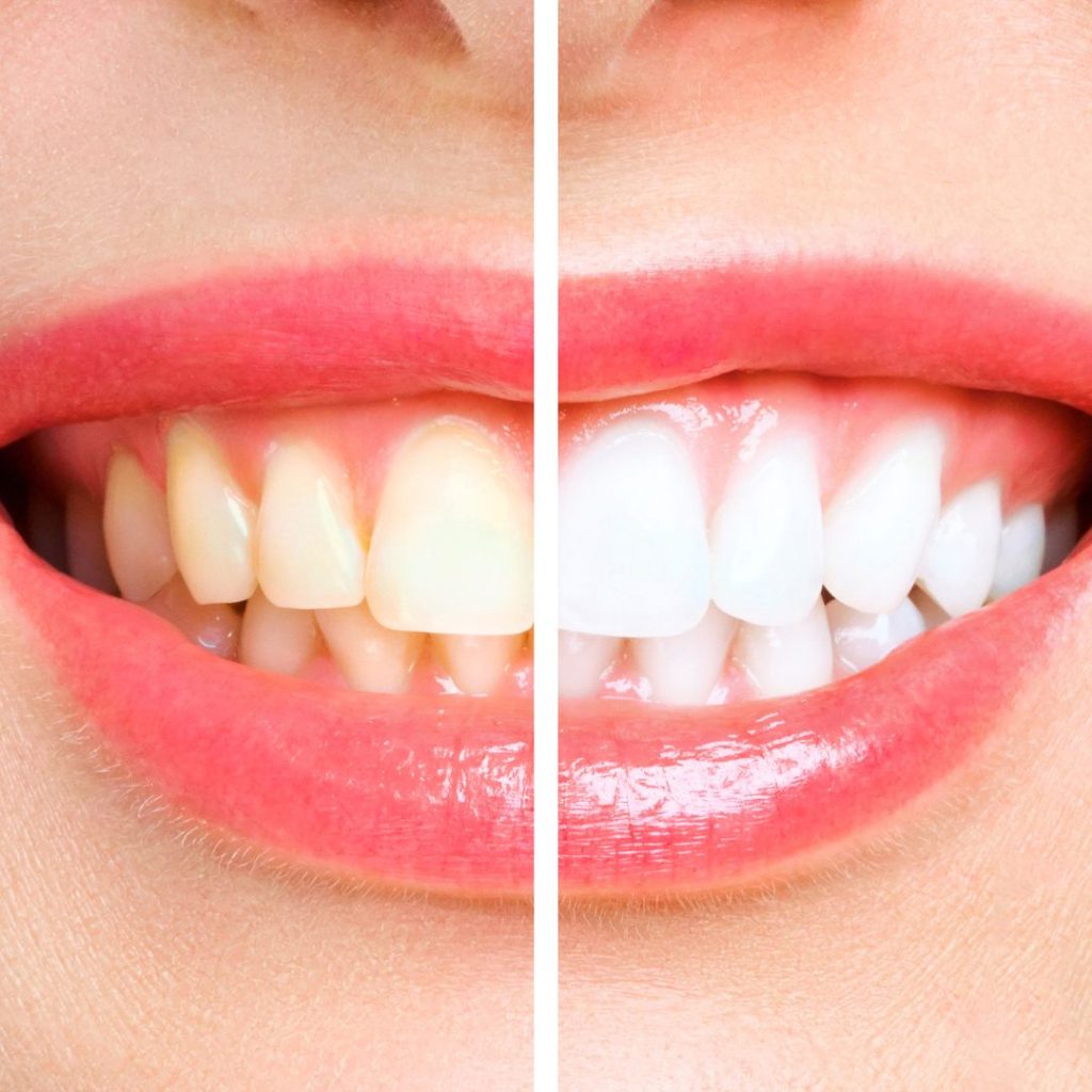 V34 Teeth Whitening